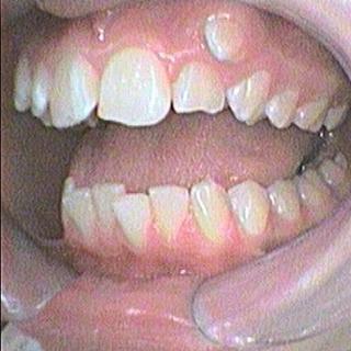 Braces and Invisalign - Before - Right Side