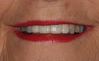 Veneers transformation 001 (after)
