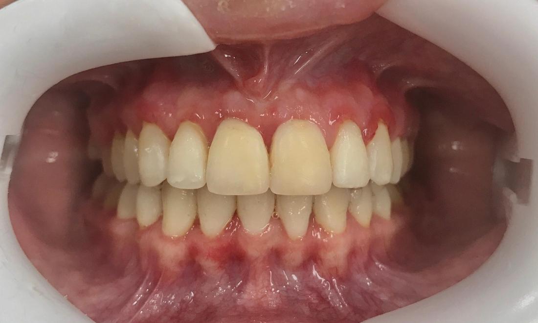 Braces and Invisalign - After