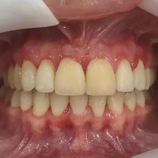 Braces and Invisalign - After
