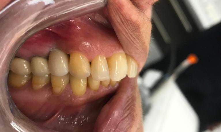Dental Implants - After - Left Side