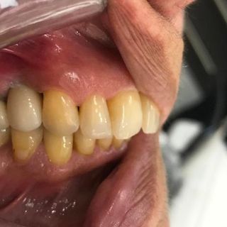 Dental Implants - After - Left Side
