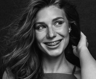Do You Have Overlapping or Unevenly Spaced Teeth?