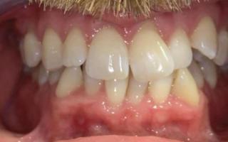 Invisalign transformation 002 (before)