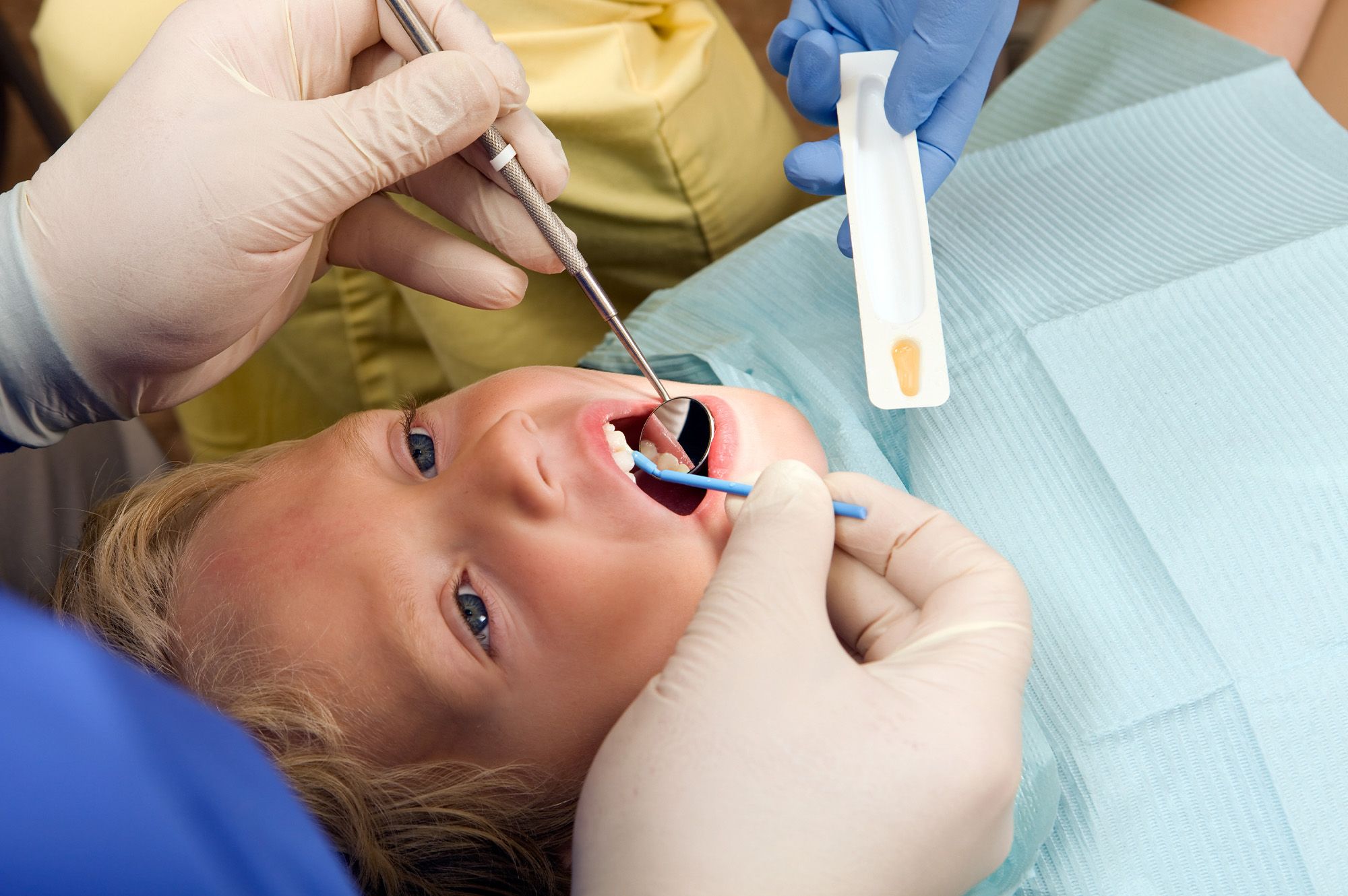 What to Expect During a Dental Sealant Treatment