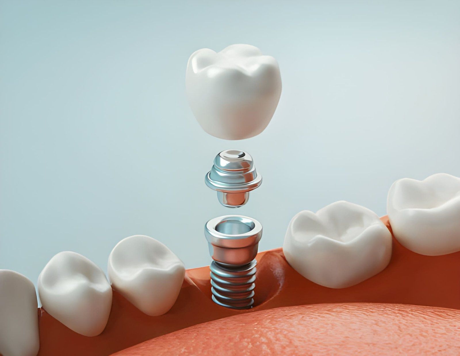 What is the Implant Process Like?