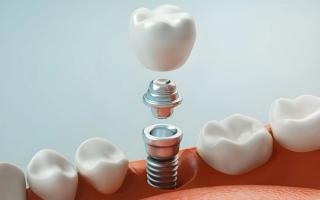 What is the Implant Process Like?
