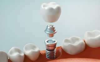 Individual Dental Implants VS All-On-4 Implants