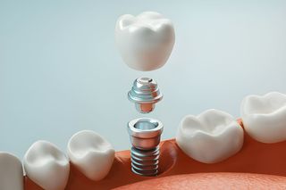 Crown Placement