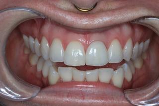 after implant