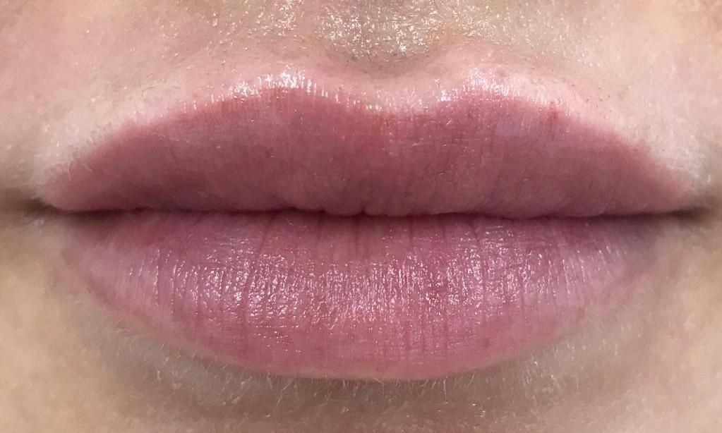 Facial Aesthetics - After