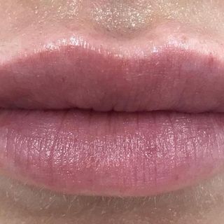 Facial Aesthetics - After