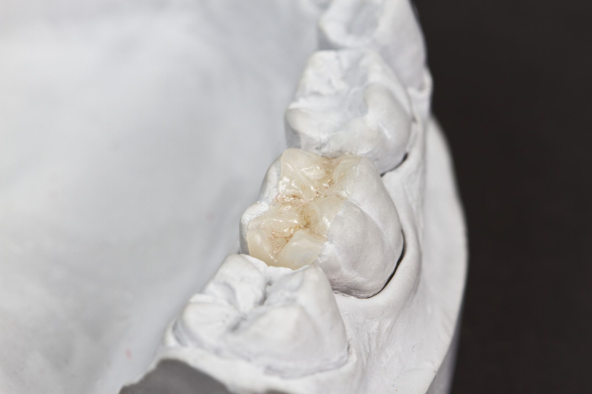 Indirect fillings