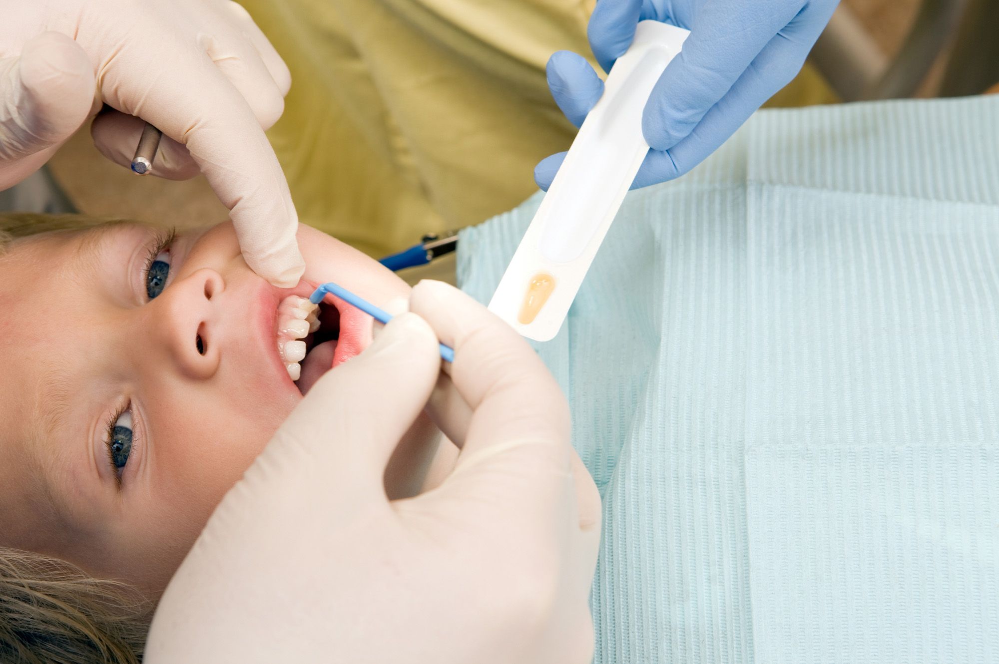 Fluoride treatments
