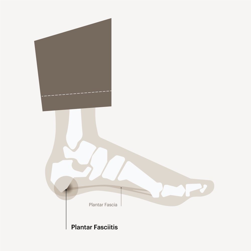 PLANTAR FASCIITIS