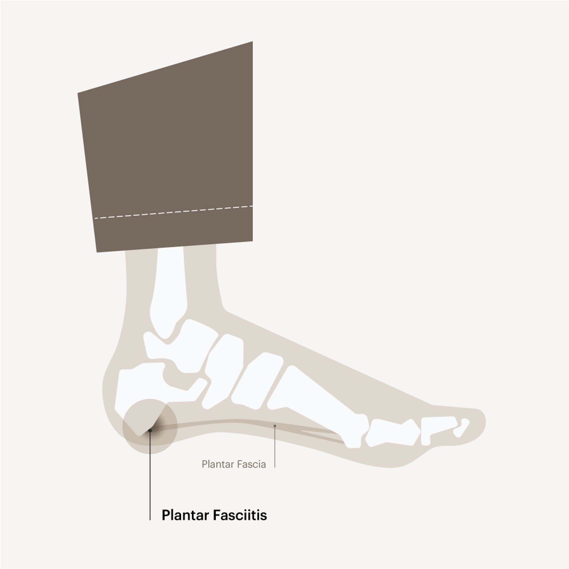 PLANTAR FASCIITIS