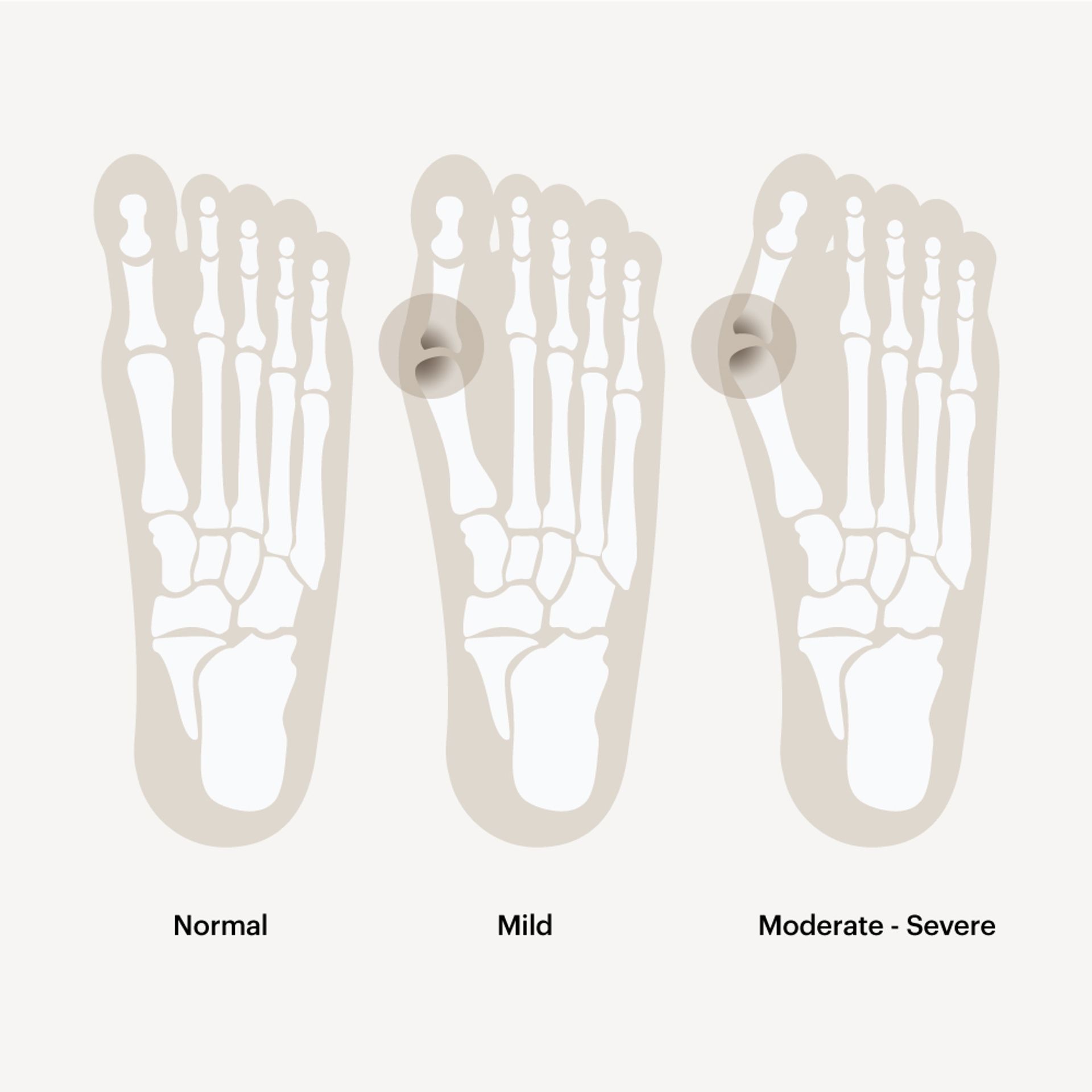 Bunions