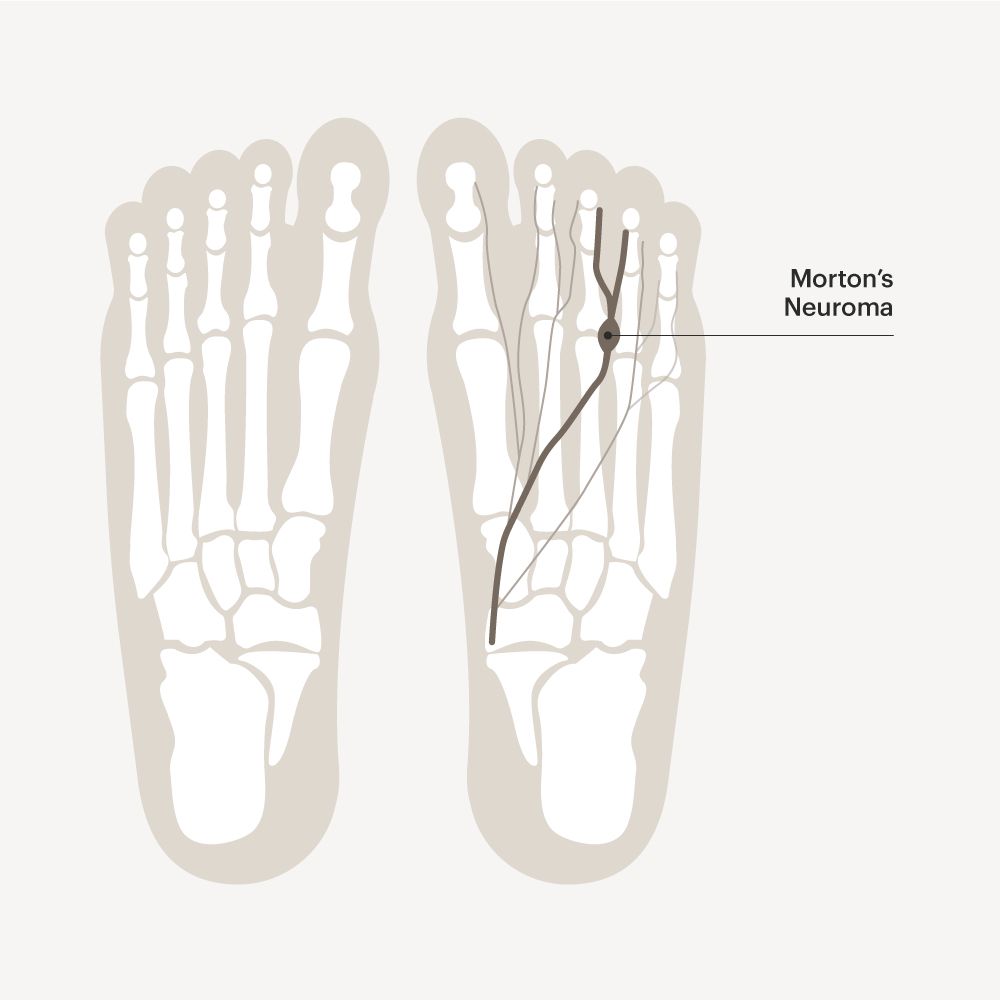 Morton's Neuroma