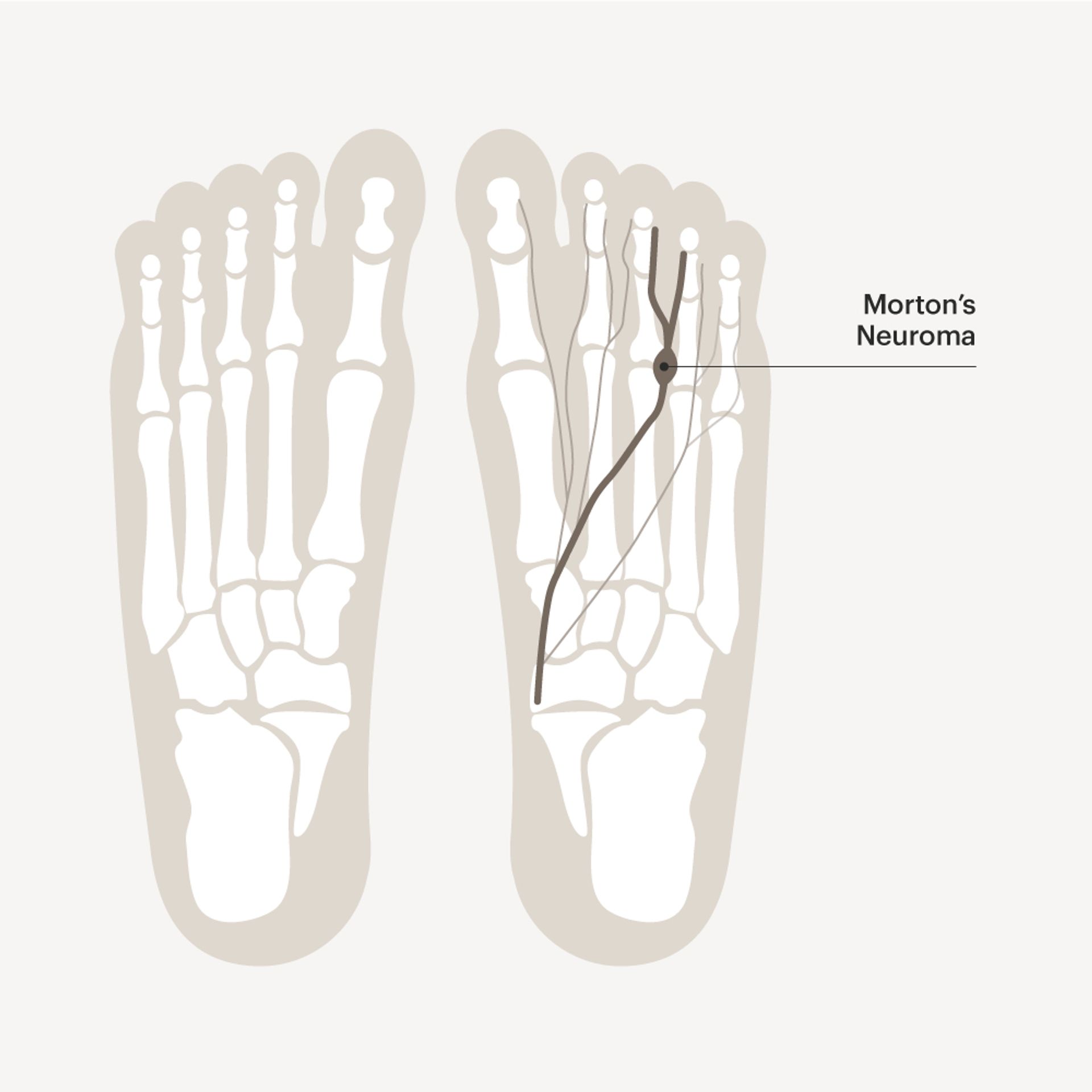 Morton's Neuroma