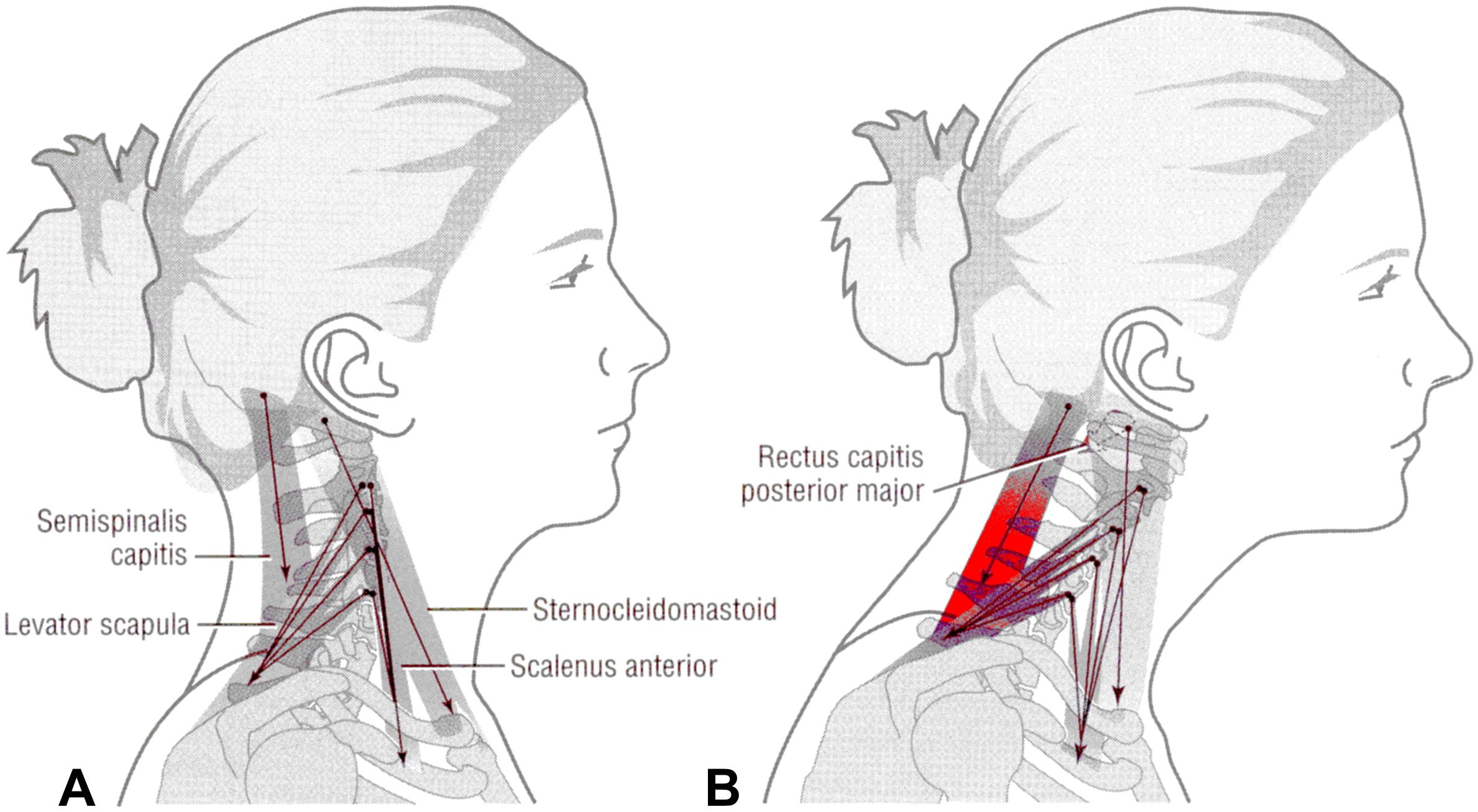 forward neck