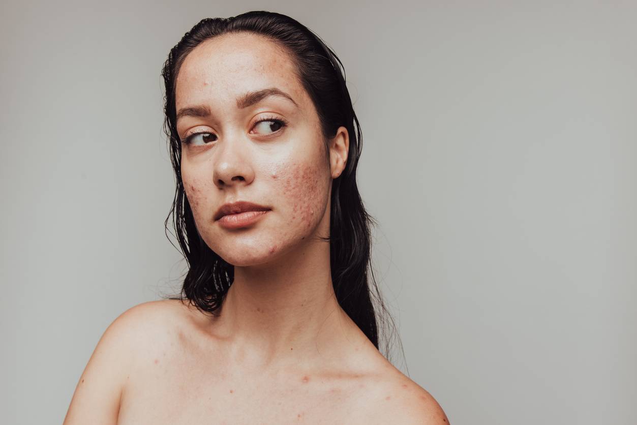 Woman with acne on her face