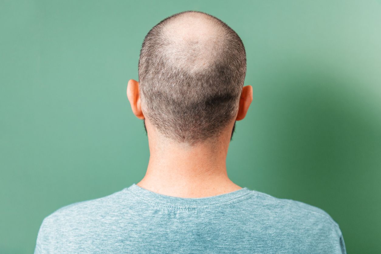 Featured image for Finasteride Dosage - How To Use It Safely
