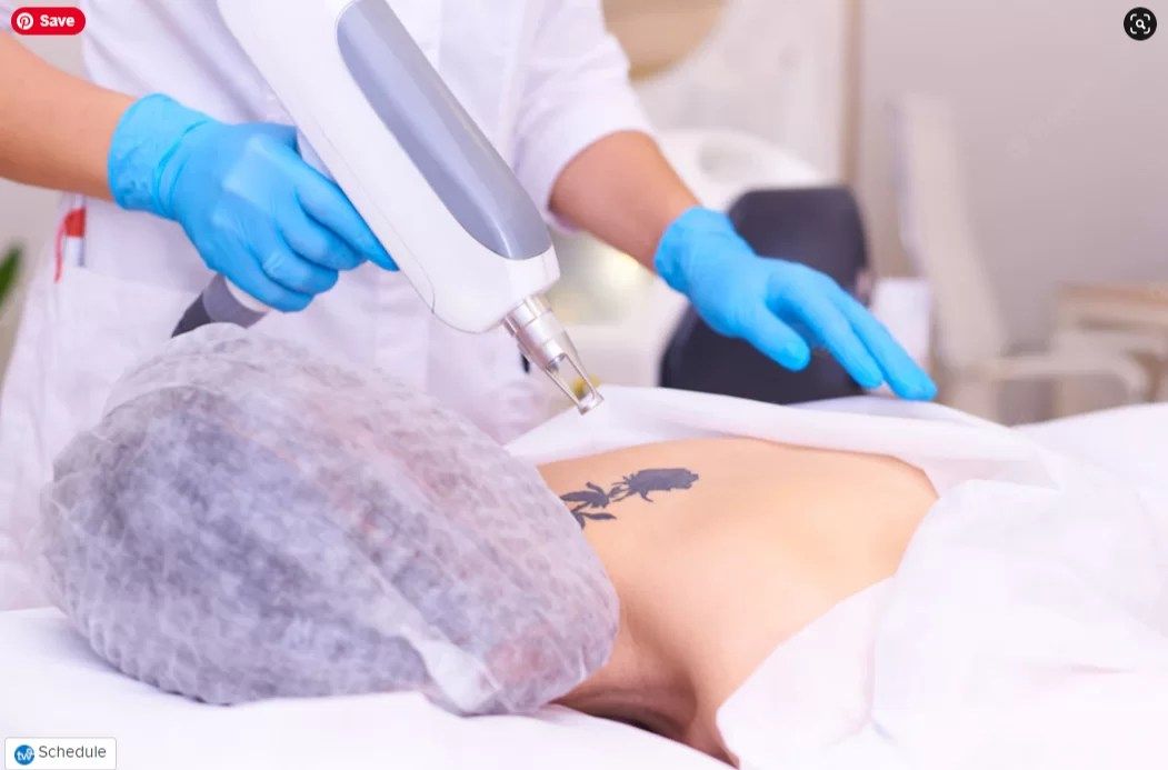 tattoo removal marketing SEO