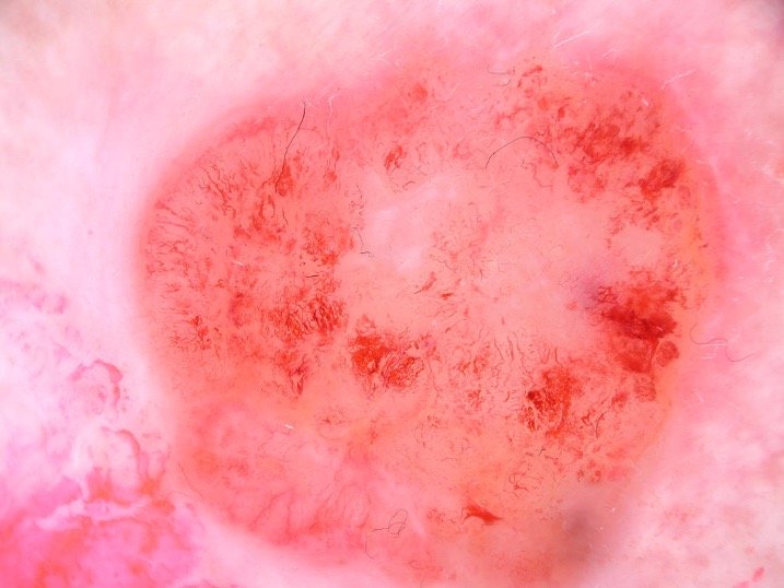 Dermoscopie