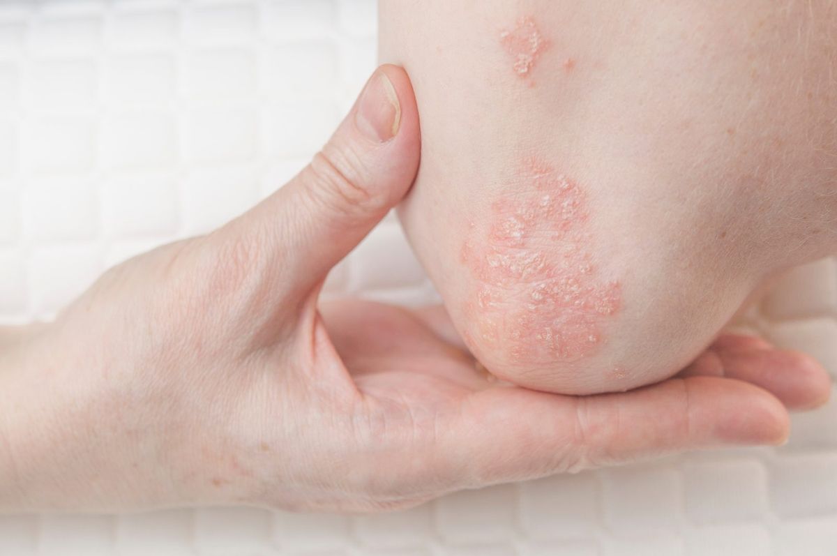 Rote, verdickte und schuppende Plaques, die charakteristisch für Psoriasis sind. Nach einigen Studien kann die übermäßige Proliferation von Keratinozyten durch systemische Entzündungen verstärkt werden, die mit einer erhöhten Darmpermeabilität und dem Übertritt mikrobiomabgeleiteter Moleküle in den Blutkreislauf verbunden sind.