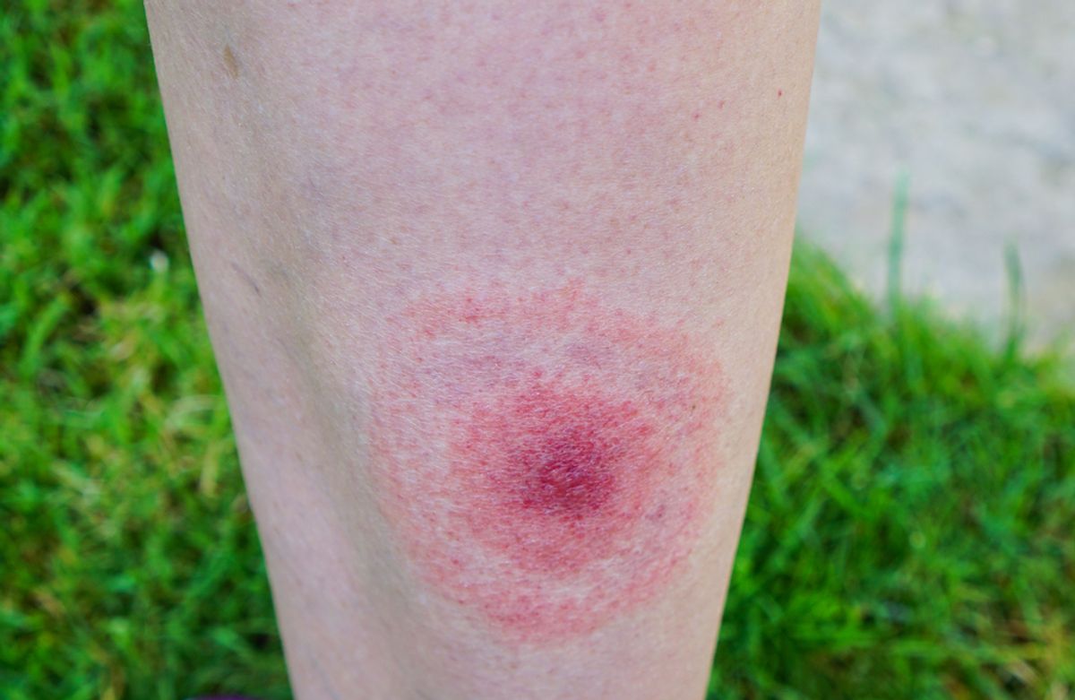 Lyme-folt, a Lyme-kór klasszikus tünete