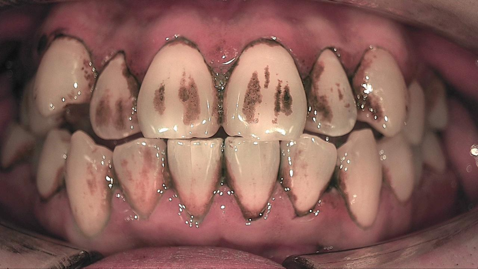 Same arch after disclosing, with broad staining along the gingival margins and interproximally