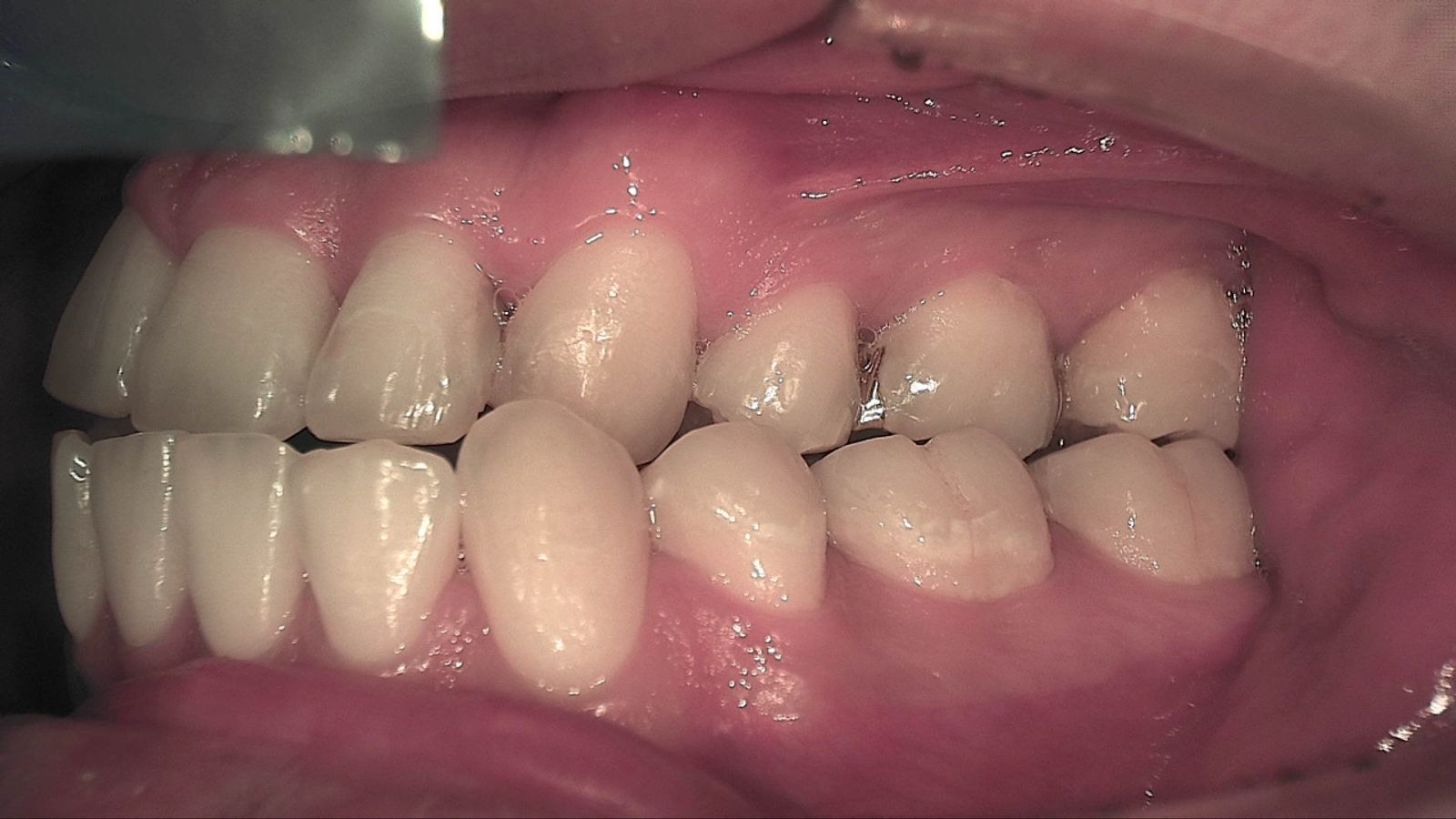 Posterior teeth under white light from the side, surfaces appearing mostly smooth