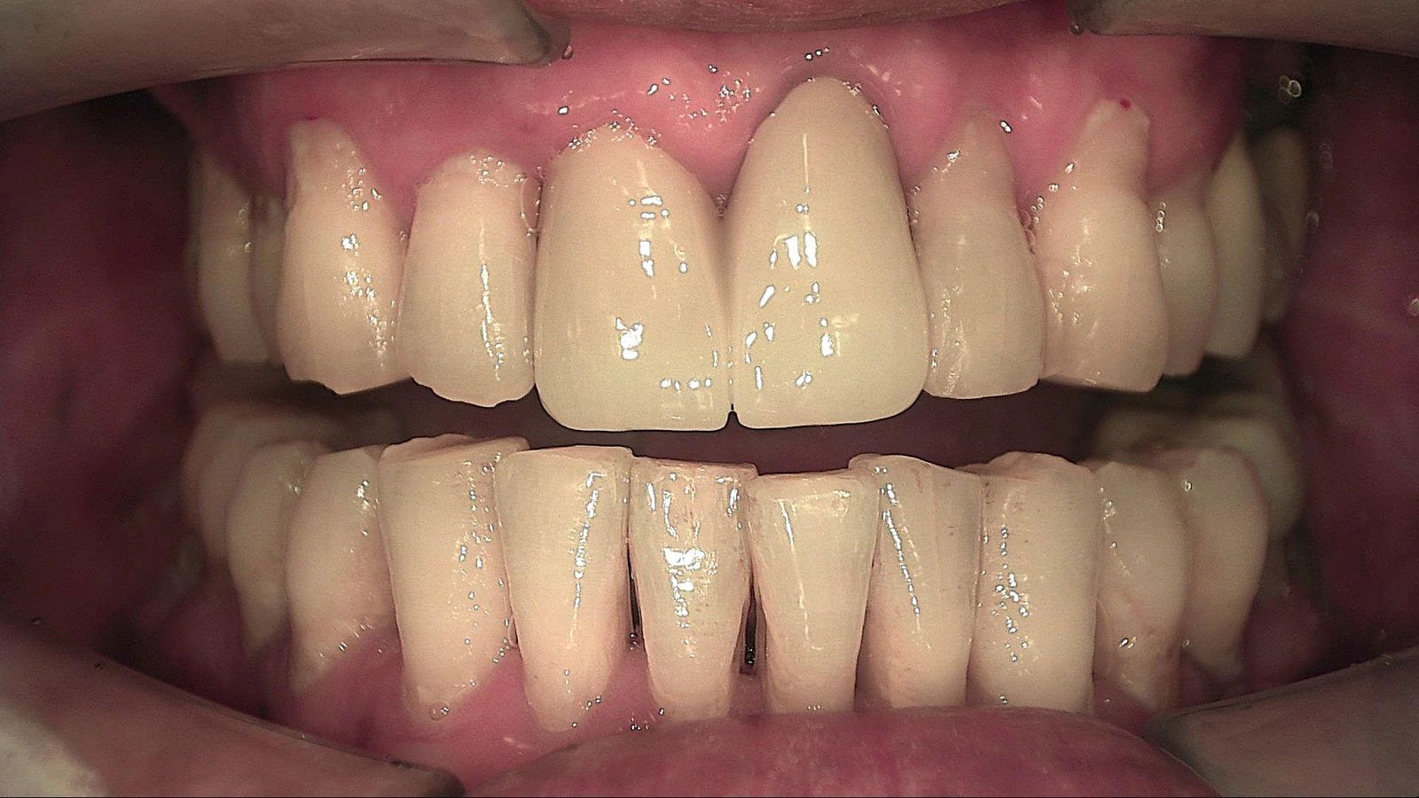 Anterior teeth under white light at the first visit, January 2024, before scaling
