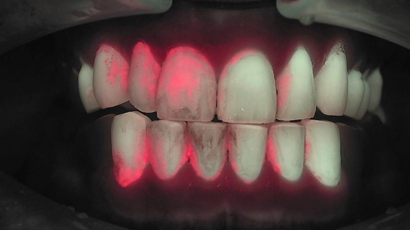 Plaque under Qray fluorescence — real clinical case