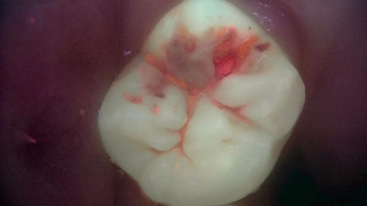 같은 치아의 Qray 형광 사진, 변색 부위에 붉은 형광과 어두운 부위가 함께 보임