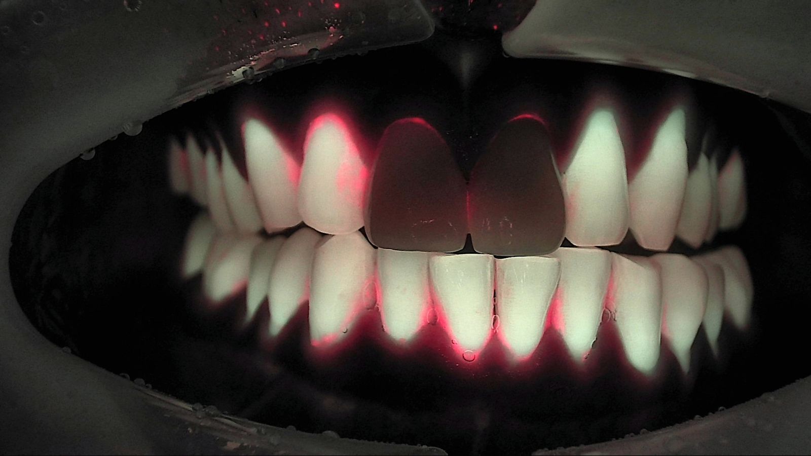 스케일링 전후 비교에 쓰는 스케일링 전 Qray 형광 사진 — 하악 전치 치경부와 치간을 따라 붉은 형광이 보이는 실제 임상 사례