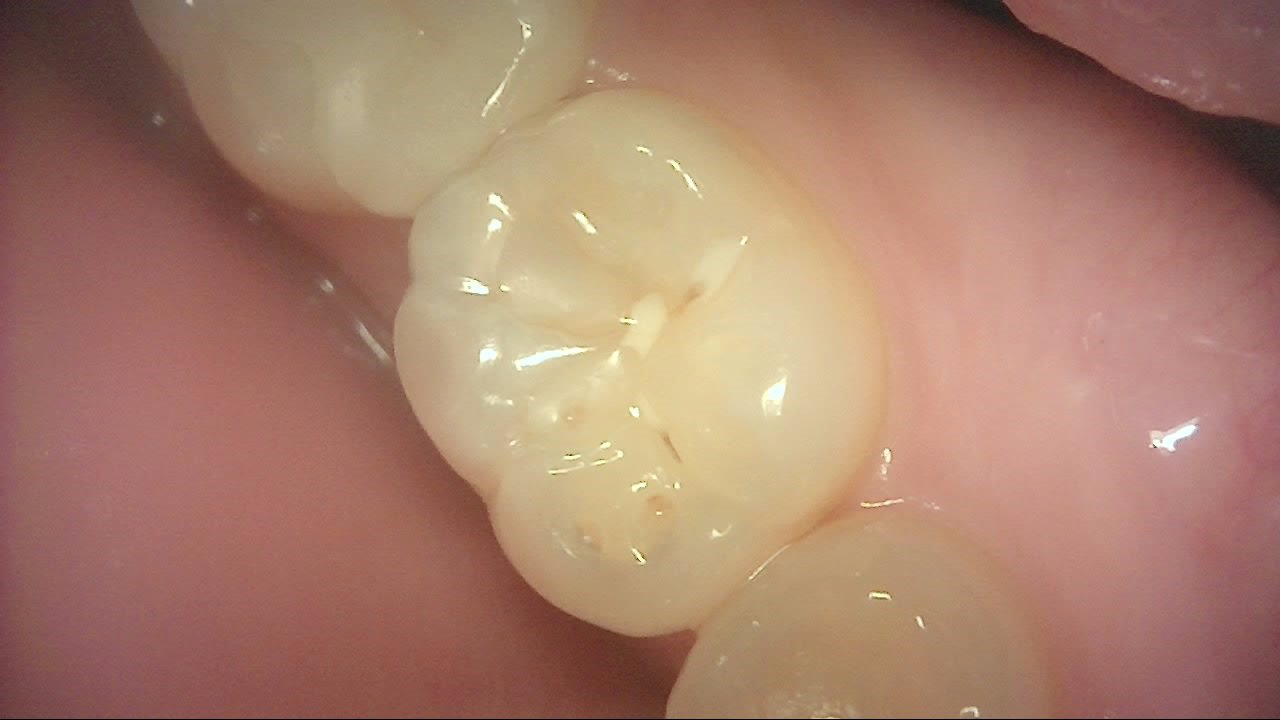 Posterior tooth, occlusal view under white light; marginal ridge looks smooth