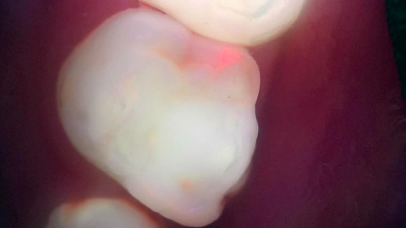 Real clinical Qray fluorescence image of a primary molar with red fluorescence at the proximal edge