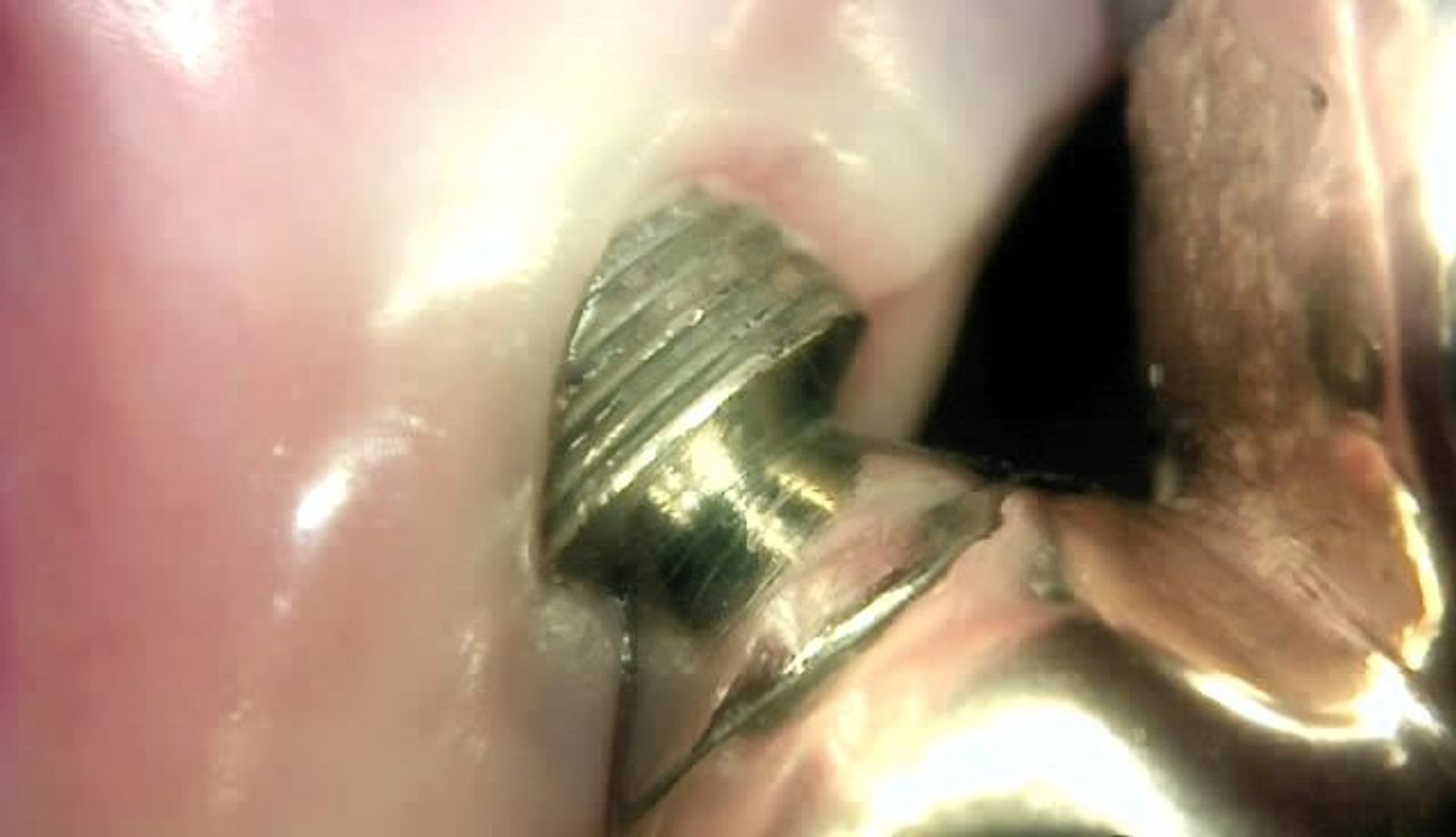 White-light image of an implant with exposed threads