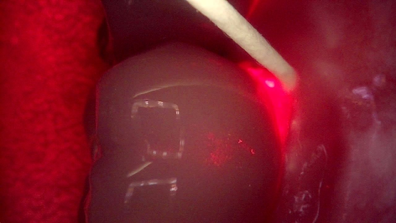 Qray fluorescence clinical image showing red fluorescence at an implant crown margin
