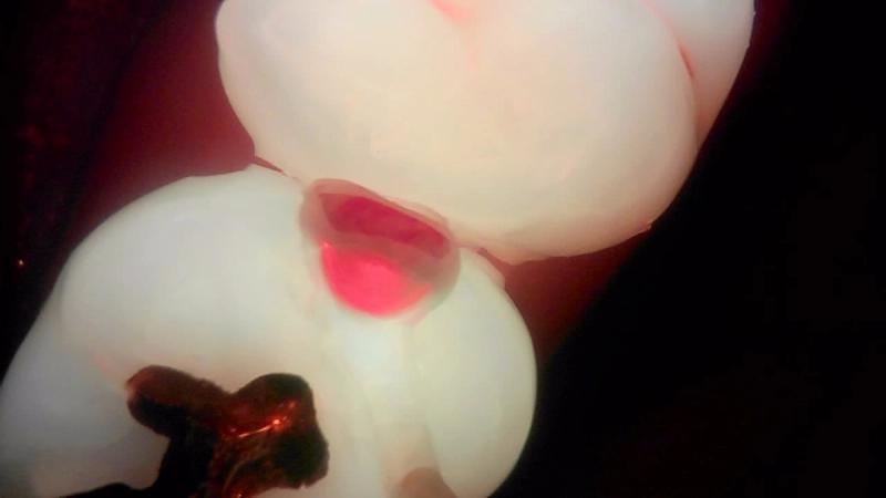 Red fluorescence in a proximal lesion under Qray fluorescence — real clinical case, unedited