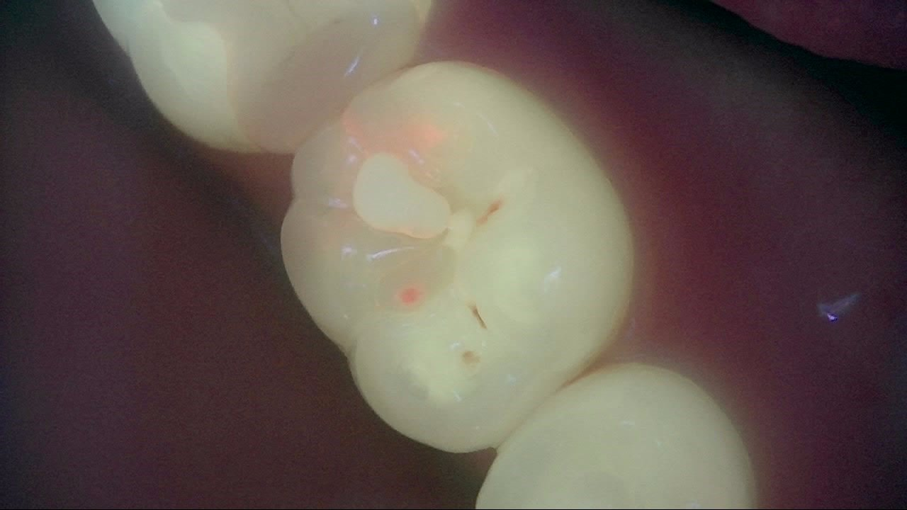 Same tooth under Qray fluorescence; faint red fluorescence near the marginal ridge