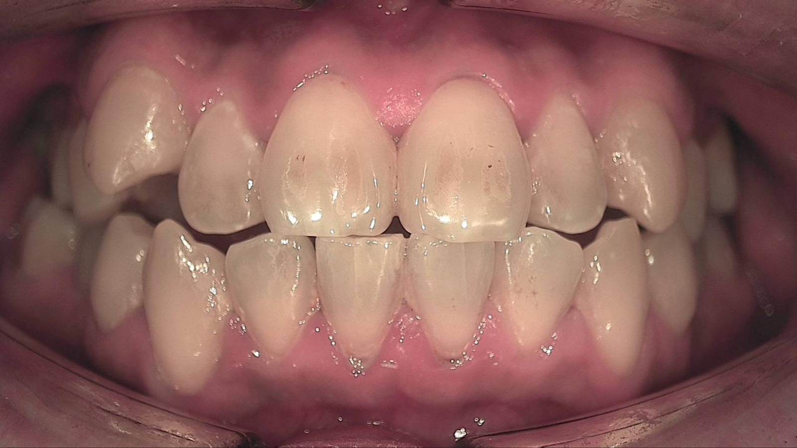 Anterior teeth under white light before scaling, with little visible plaque