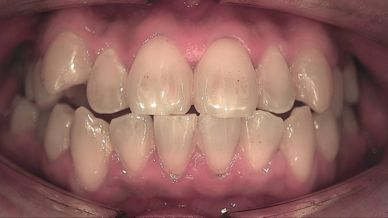 Anterior teeth under white light before scaling, with little visible plaque