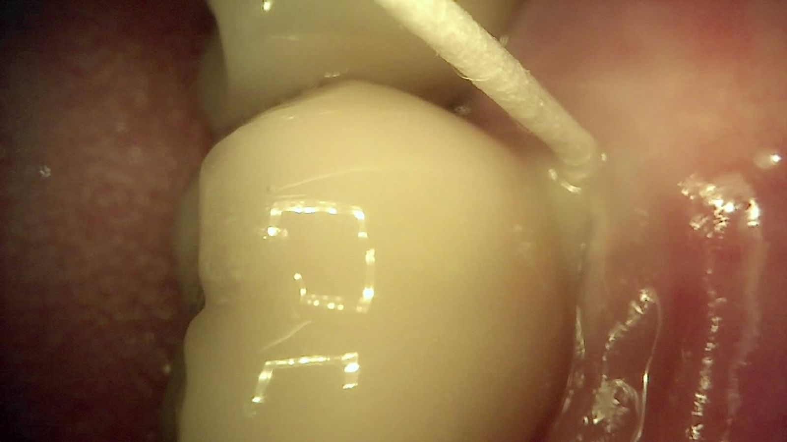 White-light image of an implant crown with a paper point at the margin