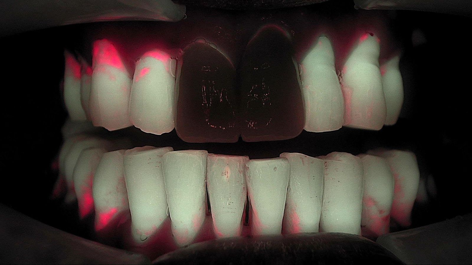 Qray fluorescence the same day, January 2024, with distinct red at the maxillary lateral and canine margins and mandibular interproximal areas