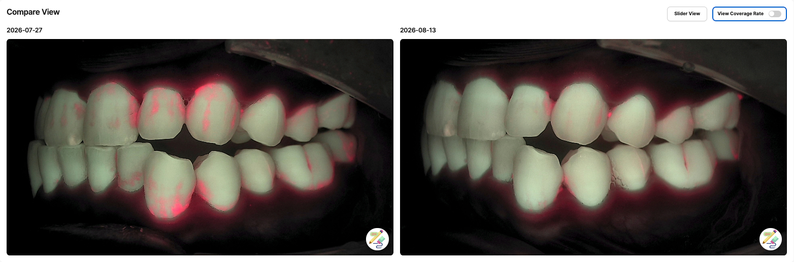 치과 환자 리포트로 보낼 수 있는 LINKDENS Compare View 화면 — 17일 간격으로 찍은 같은 환자의 Qray 형광 사진에서 붉은 부위가 줄어 보이는 실제 임상 사례