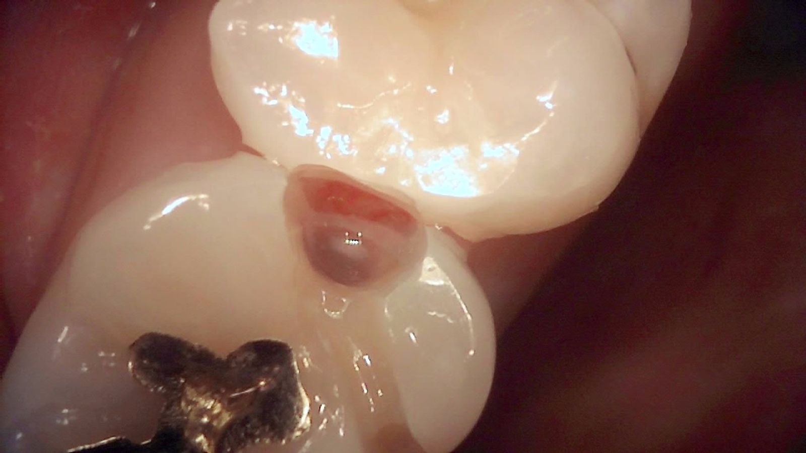 Proximal lesion area under white light, with dark brown change