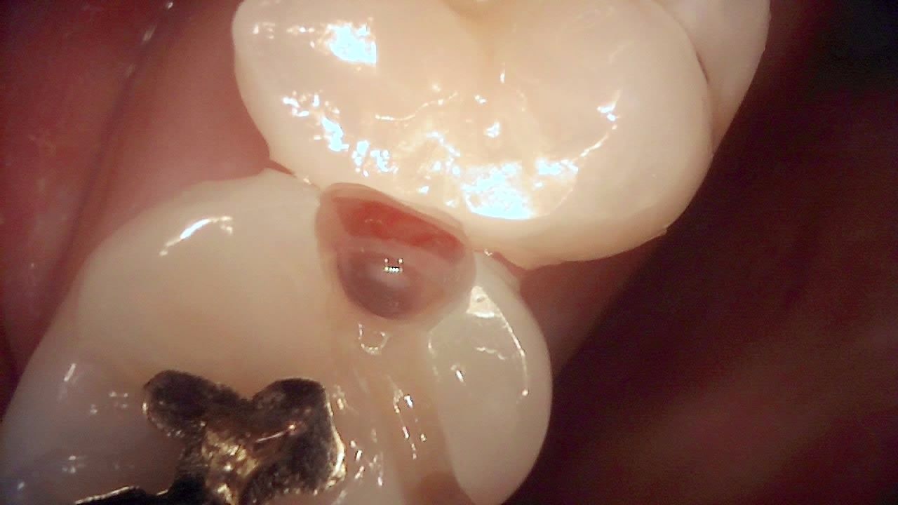 Proximal lesion area under white light, with dark brown change