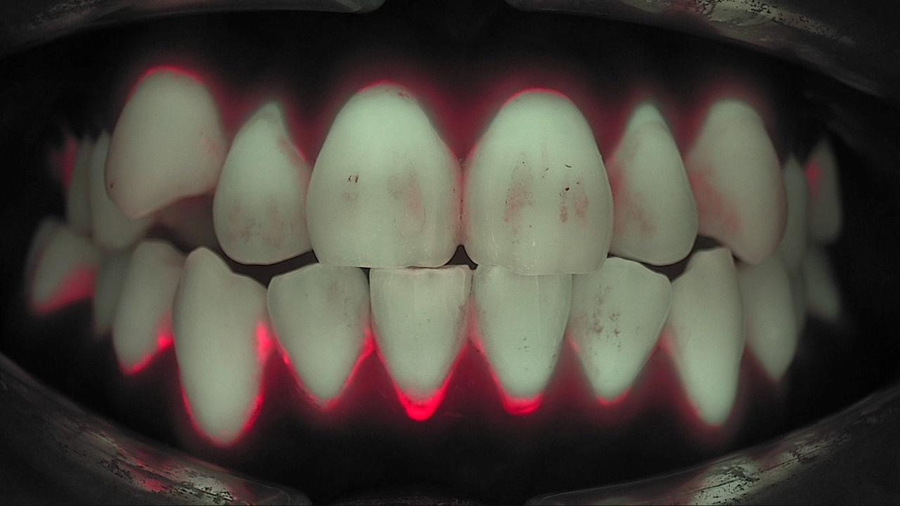 Qray fluorescence image of anterior teeth before scaling showing a red band of dental plaque fluorescence along the gingival margins, real clinical case